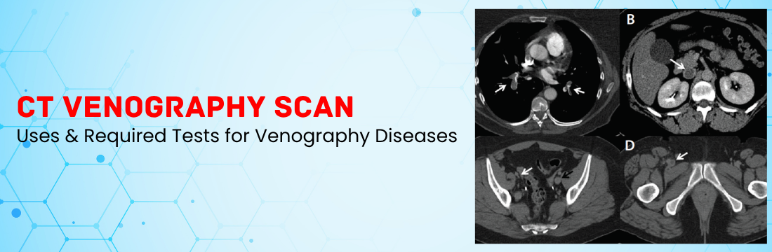 CT  Venography Scan and its Uses